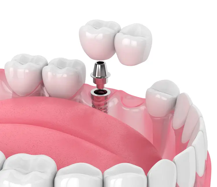 3D-Darstellung eines Zahnimplantats mit Abutment und Krone