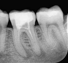 Wie ist die Prognose für einen behandelten Zahn? 